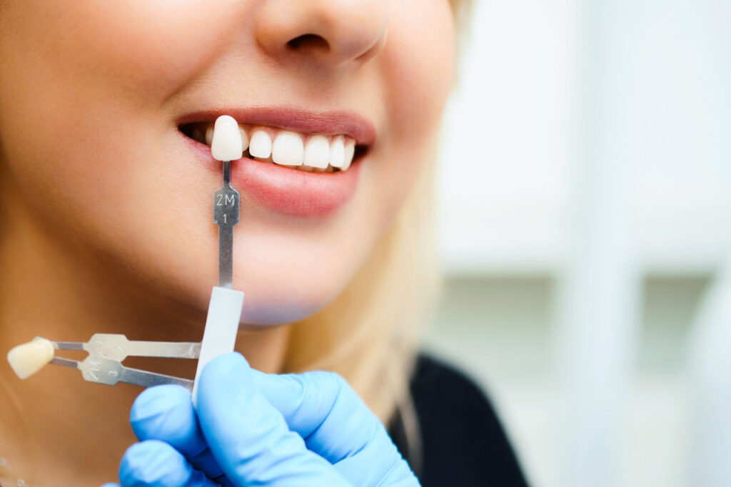 Young woman smiling with bright white teeth showing dental veneer shade matching