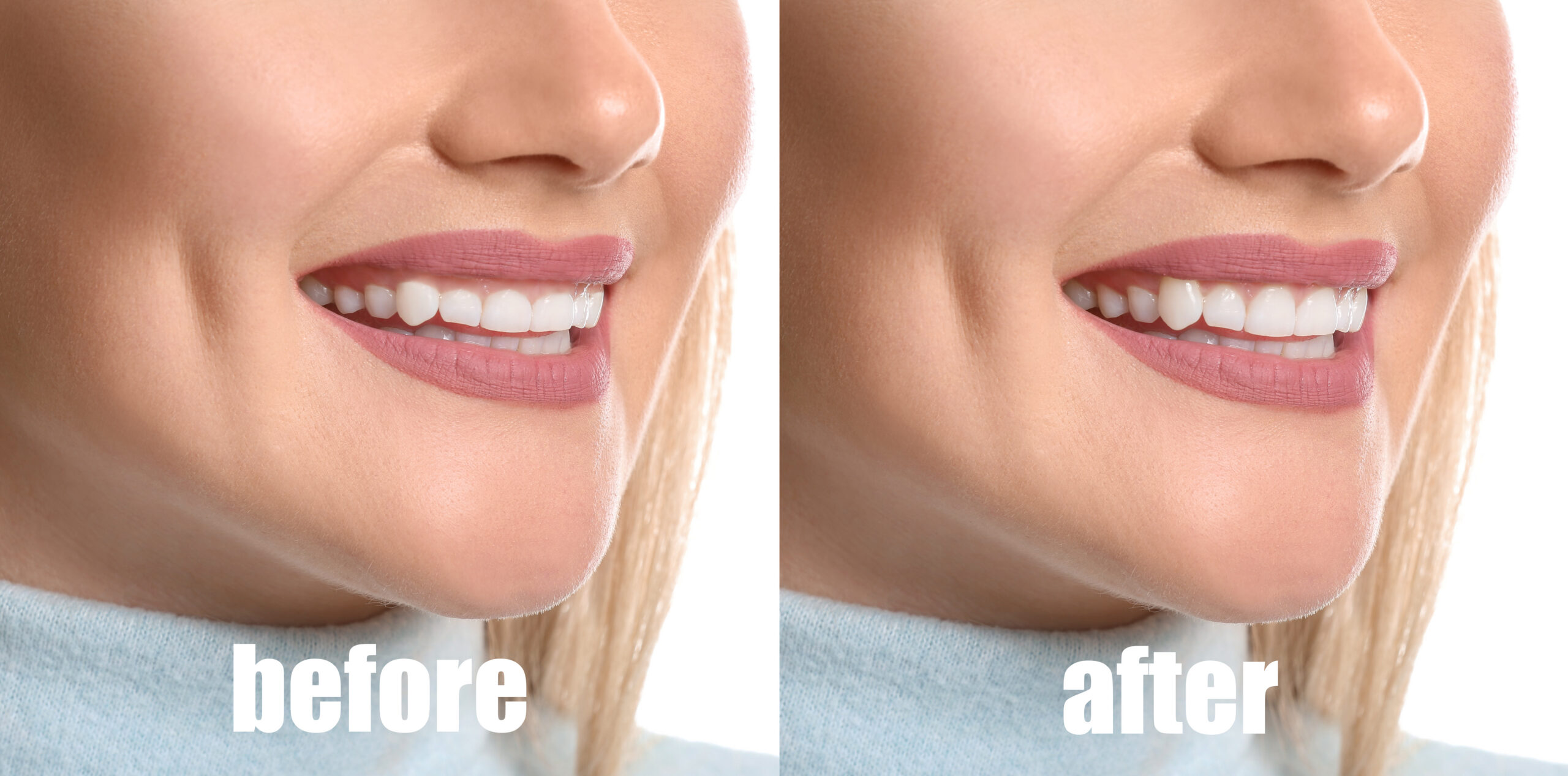 Young woman before and after procedure of gingival plasty on white background, closeup