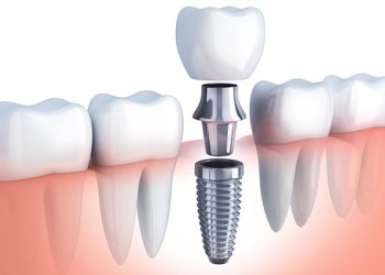 questions-to-ask-implant-dentist